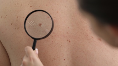 Eine Hautärztin untersucht den Rücken eines Patienten. Zu intensive Sonnenbäder ohne Sonnenschutz lassen das Risiko für Hautkrebs steigen.  | Bild: colourbox.com