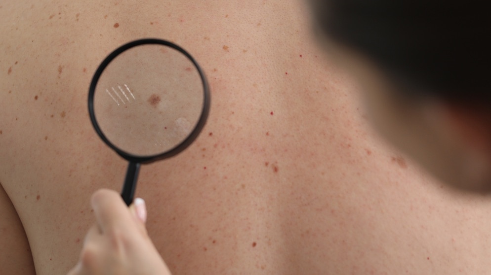 Eine Hautärztin untersucht den Rücken eines Patienten. Zu intensive Sonnenbäder ohne Sonnenschutz lassen das Risiko für Hautkrebs steigen.  | Bild: colourbox.com