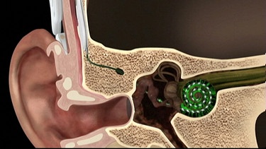Grafik Cochlea-Implantat | Bild: HR
