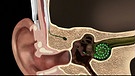 Grafik Cochlea-Implantat | Bild: HR
