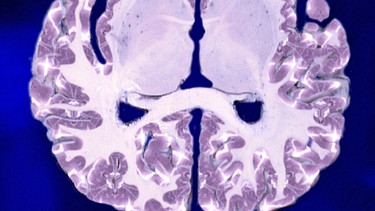 Querschnitt durch das menschliche Gehirn | Bild: BR