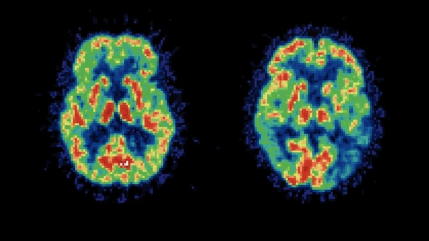 Computertomogramm vom Gehirn | Bild: Getty Images