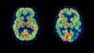 Computertomogramm vom Gehirn | Bild: Getty Images