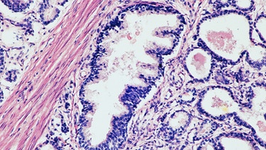 Mikroskopaufnahme einer gutartige Vergrößerung der Prostata | Bild: picture-alliance / OKAPIA KG, Germany | A.& H.-F.Michler