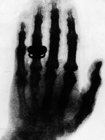 Röntgenbild von 1896: die Hand des Anatomen Albert von Kölliker. Die Aufnahme fertigte Wilhelm Conrad Röntgen am 23. Januar 1896 auf seinem ersten öffentlichen Vortrag über die Röntgenstrahlen an. Am 8. November 1895 hat er sie in Würzburg entdeckt. | Bild: picture-alliance/dpa/akg
