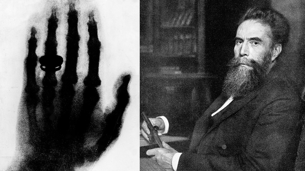 Das Röntgenbild der Hand des Anatomen Albert von Kölliker und Wilhelm Conrad Röntgen. Röntgen hat am 8. November 1895 in Würzburg die Röntgenstrahlen entdeckt. | Bild: picture-alliance/dpa/akg/Collage: BR
