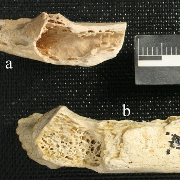 Tumor in einem Neandertalerknochen - 120.000 Jahre alt | Bild: PLOS ONE/dpa