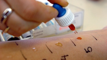 Pipette mit Allergen über Arm um die Diagnose für eine Lebensmittelallergie oder -unverträglichkeit zu stellen. | Bild: picture-alliance/dpa