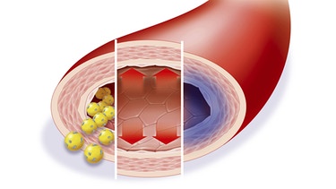 Cholesterin engt die Blutgefäße ein | Bild: picture alliance/Jacopin