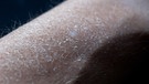 Die Haut eines Unterarms schält sich. | Bild: picture-alliance/Maximilian Schönher