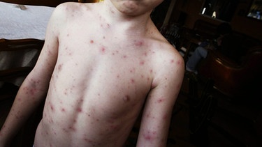 Junge mit Windpocken - Die Ständige Impfkommission am RKI empfiehlt eine Impfung gegen Windpocken im Alter zwischen 11 und 14 Monaten. | Bild: picture-alliance/dpa