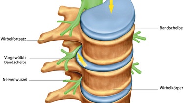 Ein Bandscheibenvorfall ist ebenfalls sehr schmerzhaft - im Bild: Illustration der Lage der Bandscheibe zwischen den Rückenwirbeln | Bild: picture-alliance/dpa