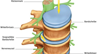 Hier eine Grafik der Bandscheiben - sie sind nicht selten Ursache für starke Rückenschmerzen | Bild: colourbox.com