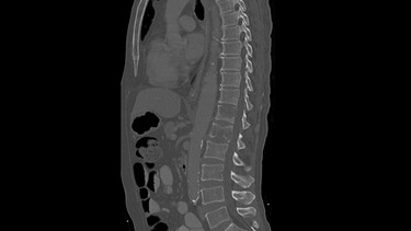 Bei Rückenschmerzen kann auch ein CT (Computertomographie) für die Diagnose helfen, wie im Bild, das eine CT-Aufnahme eines Rückens zeigt. | Bild: Klinikum rechts der Isar Michael Stobrawe