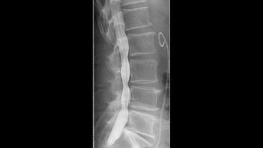 Bei Rückenschmerzen ist die Myelografie ein mögliches Diagnoseverfahren. Der Arzt spritzt ein Kontrastmittel in den Wirbelkanal, wie hier in der Aufnahme zu sehen. | Bild: Klinikum rechts der Isar Michael Stobrawe