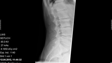 Bei Rückenschmerzen kann ein Röntgenbild für die Diagnose helfen - wie hier im Bild die seitliche Aufnahme einer LWS. | Bild: Klinikum rechts der Isar Michael Stobrawe