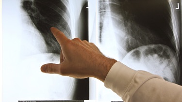 Rückenschmerzen und Röntgen - nicht immer muss das sein. Im Bild: Hand zeigt auf Röntgenbild | Bild: picture-alliance/dpa