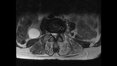 Bei Rückenschmerzen kann auch eine Kernspintomographie für die Diagnose helfen, wie im Bild, das eine entsprechende Aufnahme eines Rückens zeigt. | Bild: Klinikum rechts der Isar Michael Stobrawe