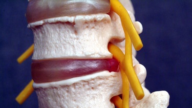 Auschnitt eines Wirbelsäulen-Modells mit Wirbelkörper (weiß), Bandscheiben (rot) und dem austretenden Spinalnerv (gelb). Bei einer Spinalkanalstenose engt eine Knochen- oder Bänderwucherung den Kanal des Spinalnervs ein und verursacht so Schmerzen und Schwächeerscheinungen. | Bild: picture-alliance/dpa