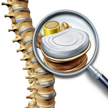 Aufbau eines Wirbels mit Bandscheibe. Bei einem Bandscheibenvorfall kann Masse der Bandscheibe auf Nerven oder Rückenmark drücken und verursacht so Rückenschmerzen oder Lähmungserscheinungen. | Bild: colourbox.com