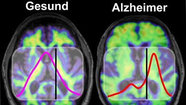 Im Gehirn von Menschen mit Alzheimer kommt es zu krankhaften Ablagerungen des Proteins Amyloid-Beta, die mit bildgebenden Verfahren wie PET sichtbar gemacht werden können (rechts).  | Bild: K. Gerwert, A. Nabers/RUB