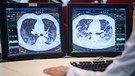 Auf zwei Monitoren sind am Klinikum Stuttgart Computertomographieaufnahmen der Lunge eines Covid19-Patienten zu sehen.  | Bild: picture alliance/dpa | Sebastian Gollnow
