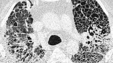 Computertomographie-Aufnahme der Lunge eines Patienten mit Covid-19-Lungenversagen. Die hellen Bereiche zeigen die Verdichtungen und Vernarbungen des Lungengewebes. | Bild: Charité
