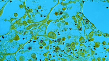 Herpes zoster Gewebsschnitt Mikroaufnahme  | Bild: picture-alliance / OKAPIA KG, Germany | Norbert Lange