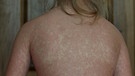 Masern verursachen juckende rote Hautausschläge. | Bild: picture alliance/KEYSTONE