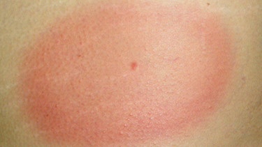 Vorsicht! Wer nach einem Zecken-Stick so einen roten Fleck hat, sollte sich auf Borreliose untersuchen lassen. | Bild: Redaktion Gesundheit!